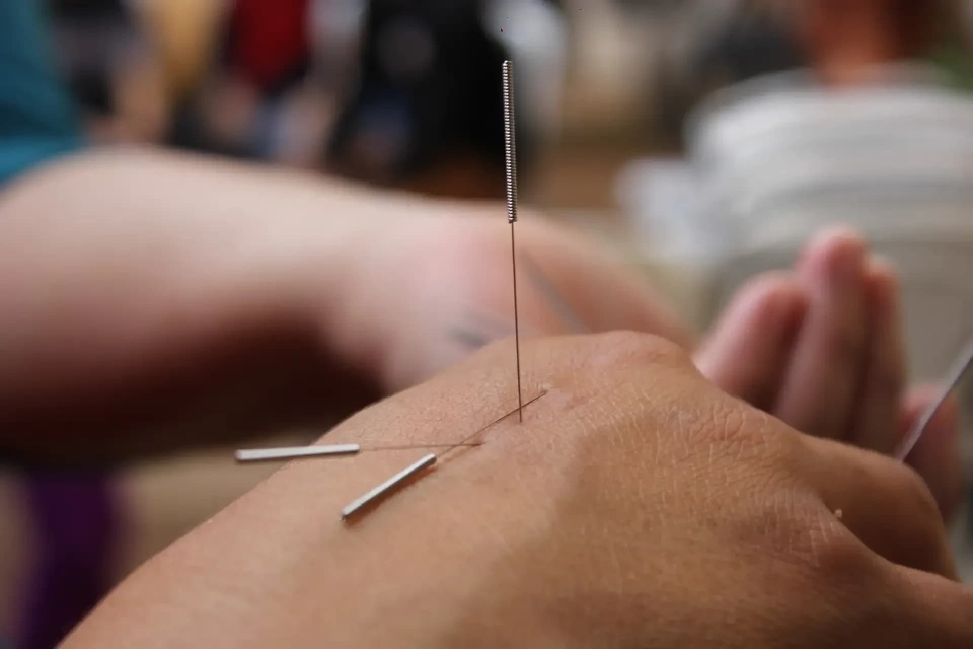 Dry Needling – Effektiv smärtlindring med nålteknik